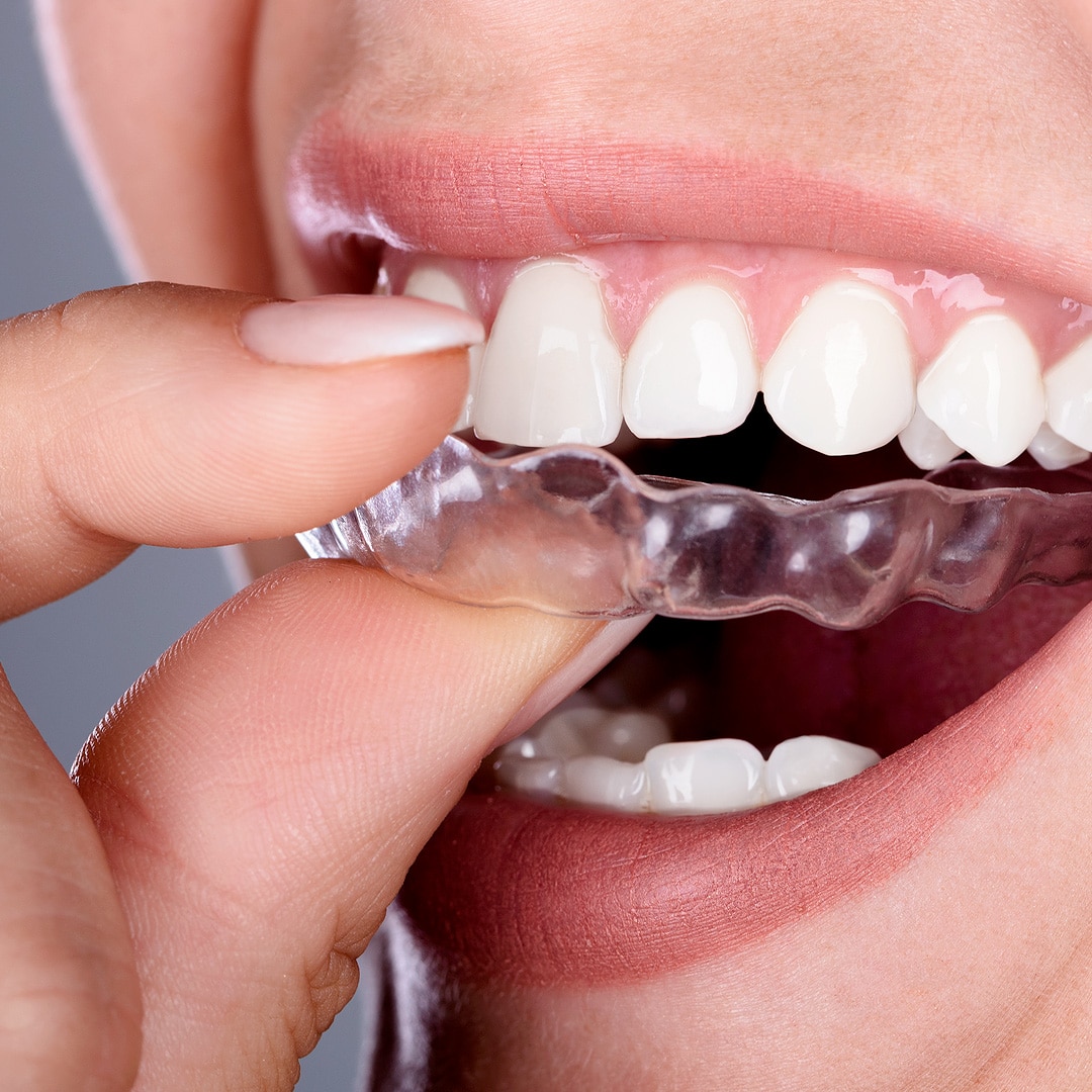 Sociedade Brasileira de Ortodontia promove curso sobre Invisalign